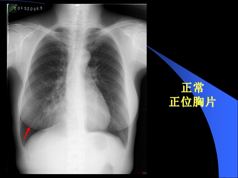 临床常见X光片解读ppt课件.ppt_第3页