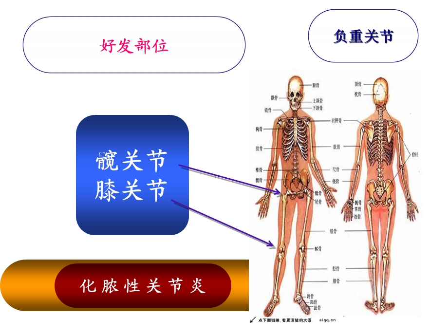 化脓性关节炎讲课用课件.pptx_第3页