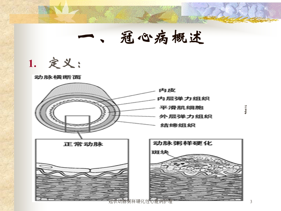 冠状动脉粥样硬化性心脏病护理培训课件.ppt_第3页