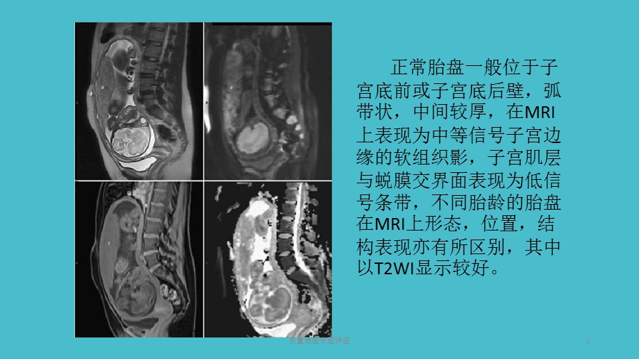 前置胎盘专题讲座培训课件.ppt_第2页