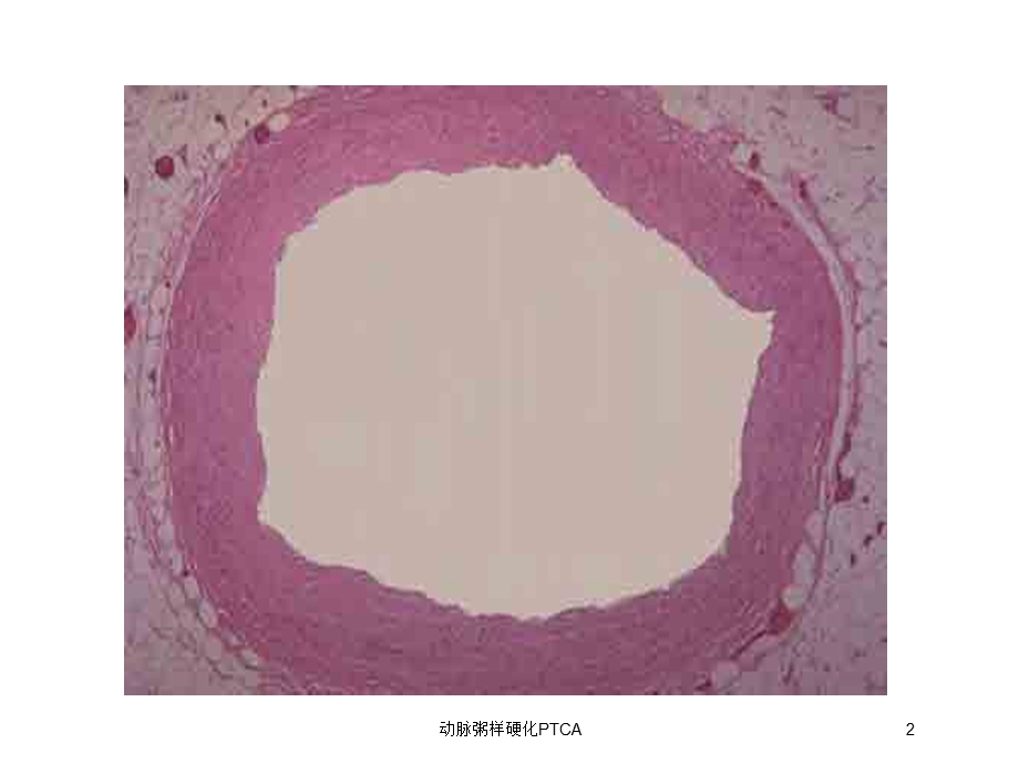 动脉粥样硬化PTCA培训课件.ppt_第2页