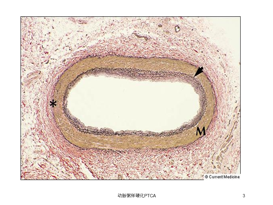 动脉粥样硬化PTCA培训课件.ppt_第3页