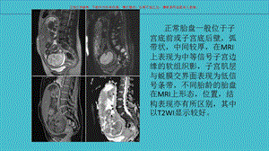 前置胎盘专题讲座课件.ppt