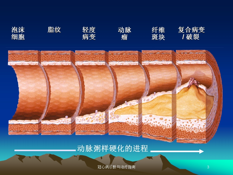 冠心病诊断与治疗指南培训课件.ppt_第3页