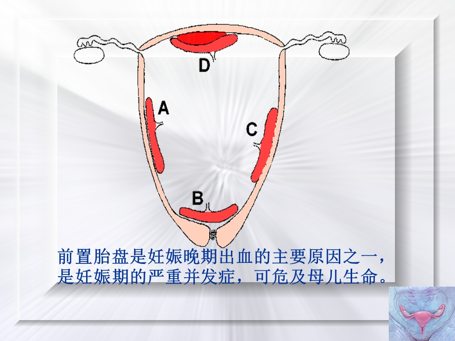 前置胎盘临床诊断与处理指南培训课件.ppt_第3页