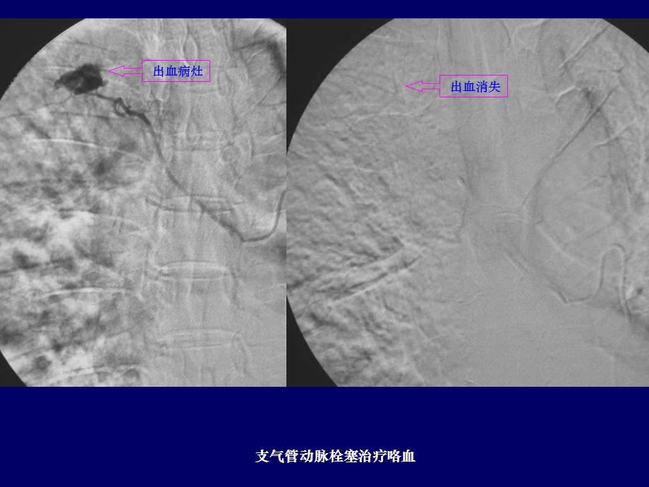 介入治疗课件胸腹部.ppt_第3页