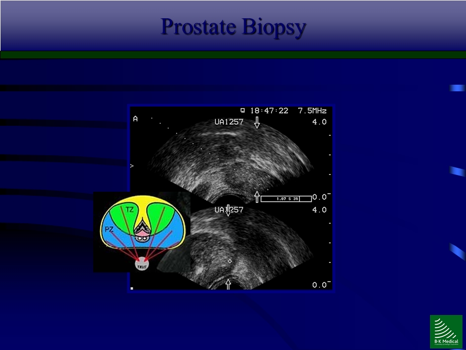 前列腺疾病的超声诊断培训课件.ppt_第2页