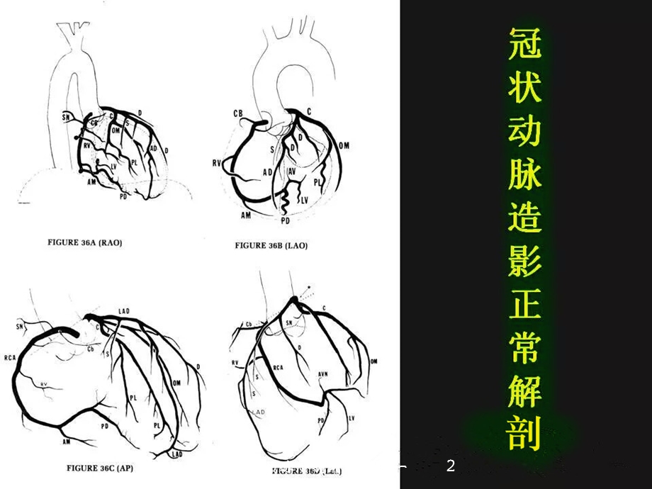 冠状动脉解剖精细到每一个分段培训课件.ppt_第2页