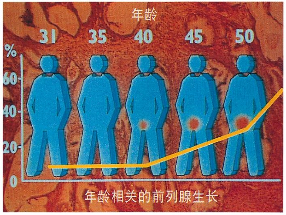 前列腺增生医疗护理专题宣讲课件.ppt_第2页