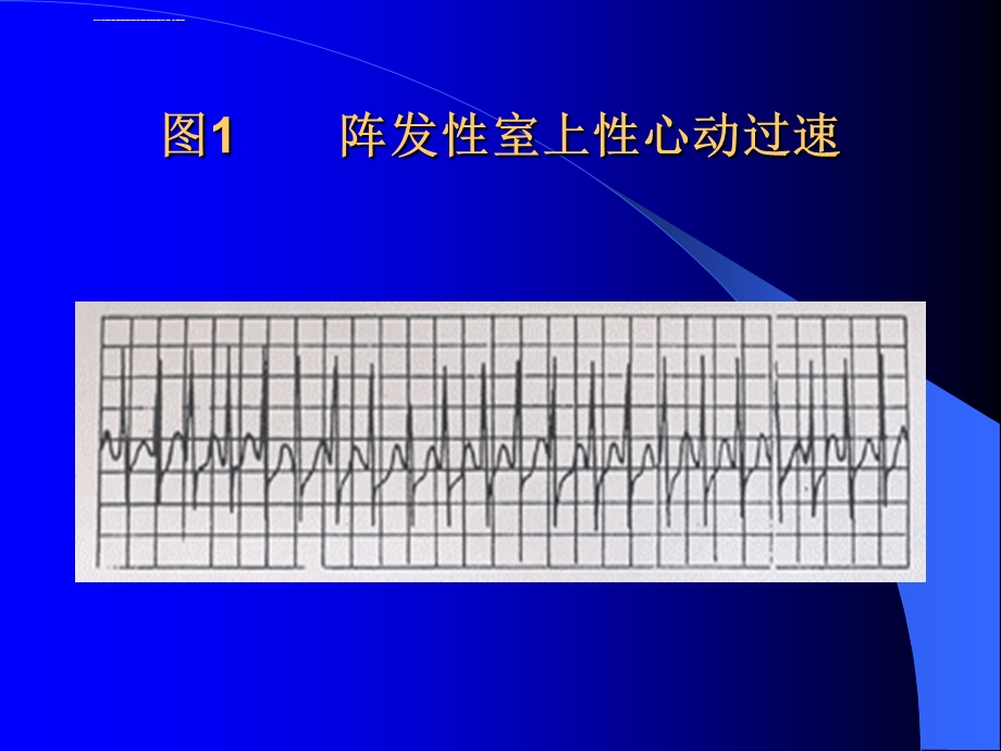 严重心律失常的诊断和急救处理ppt课件.ppt_第3页