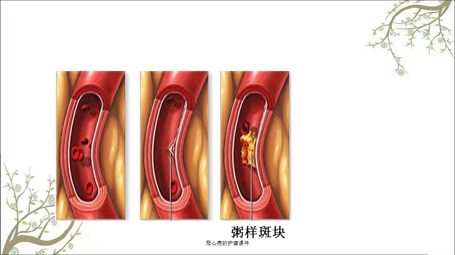 冠心病的护理课件.ppt_第3页