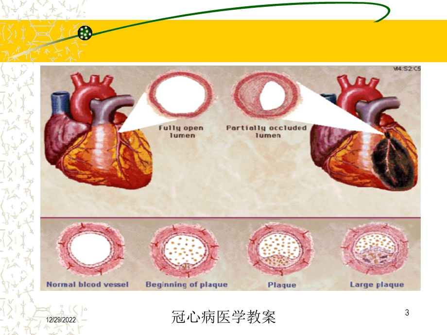 冠心病医学教案课件.ppt_第3页