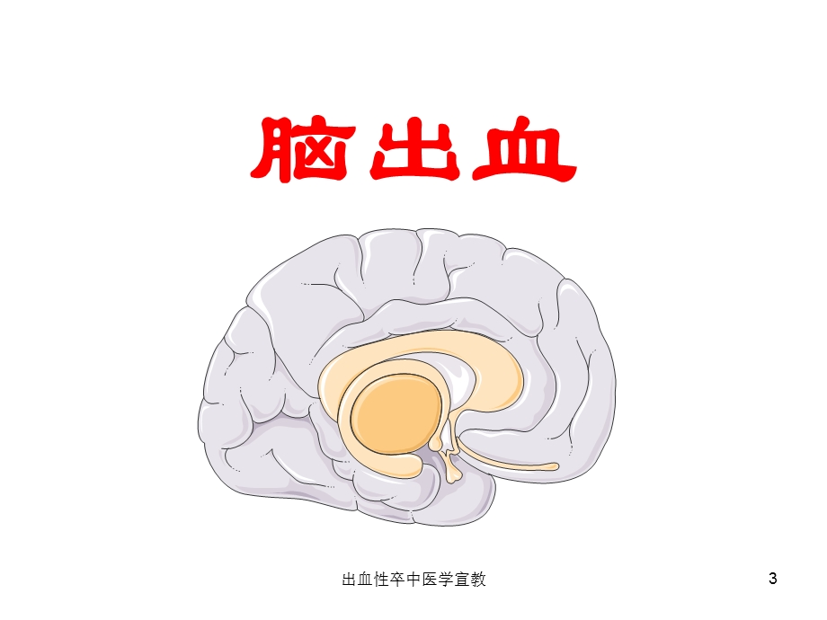 出血性卒中医学宣教培训课件.ppt_第3页