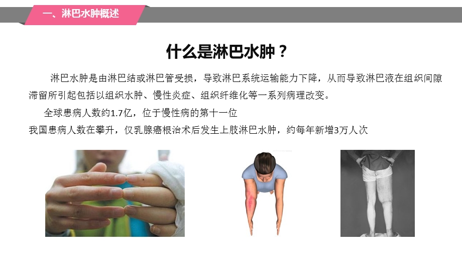 乳腺癌术后淋巴水肿ppt课件.pptx_第3页