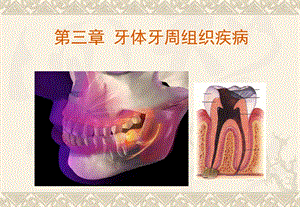 《第三章牙体牙周组织疾病》ppt课件.ppt