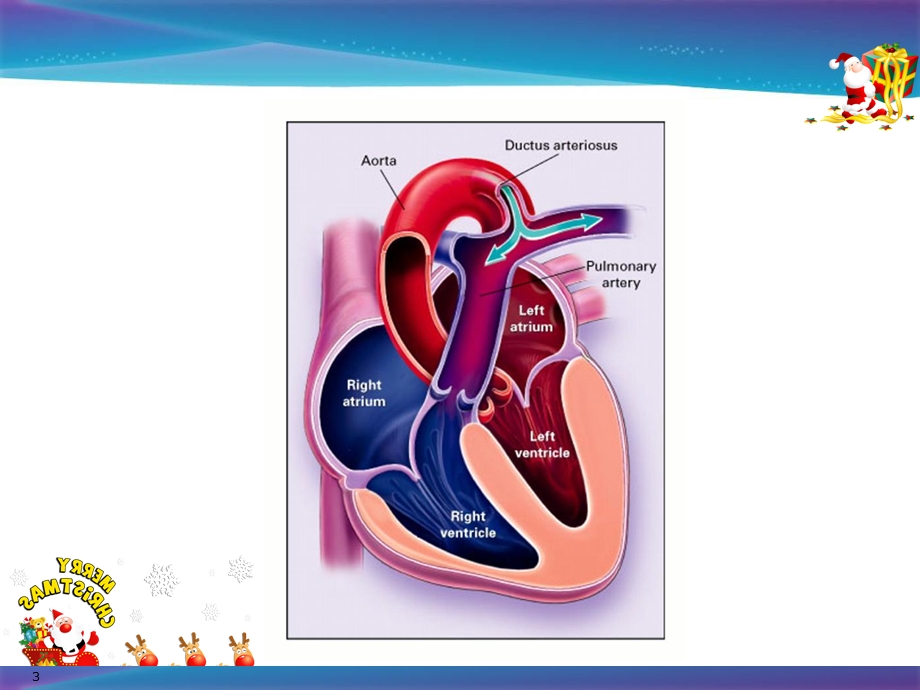 动脉导管未闭参考课件.ppt_第3页