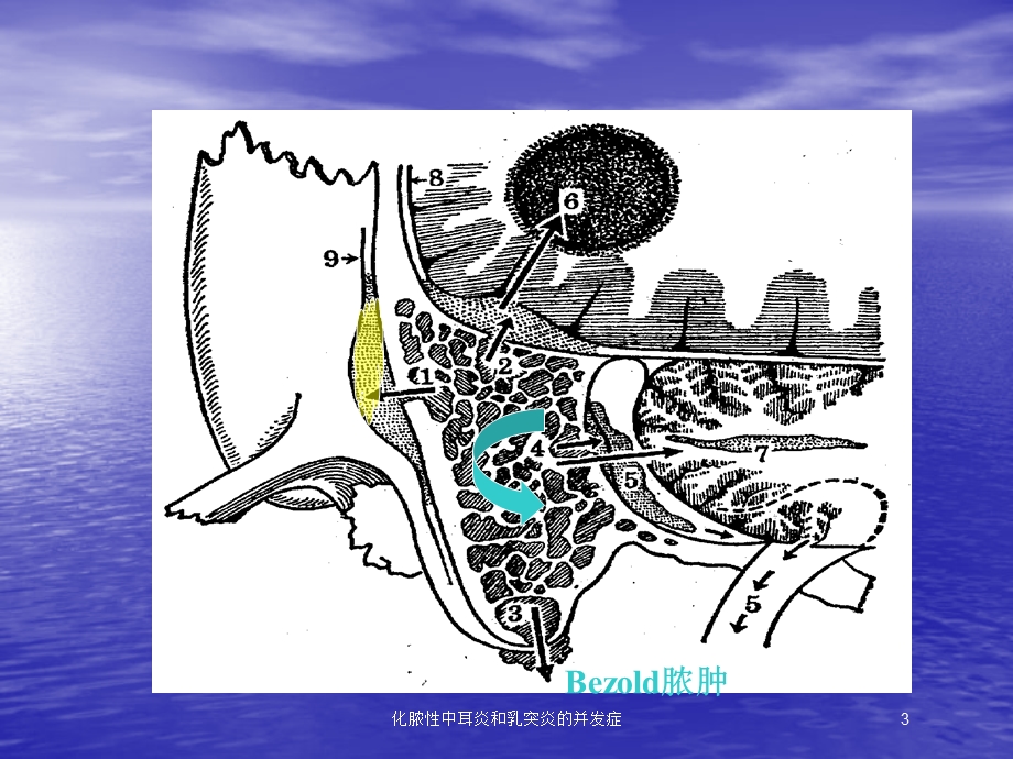 化脓性中耳炎和乳突炎的并发症培训课件.ppt_第3页