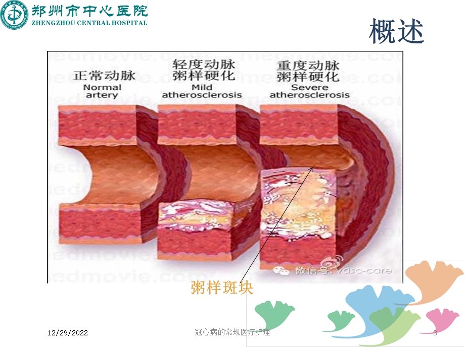 冠心病的常规医疗护理课件.ppt_第3页