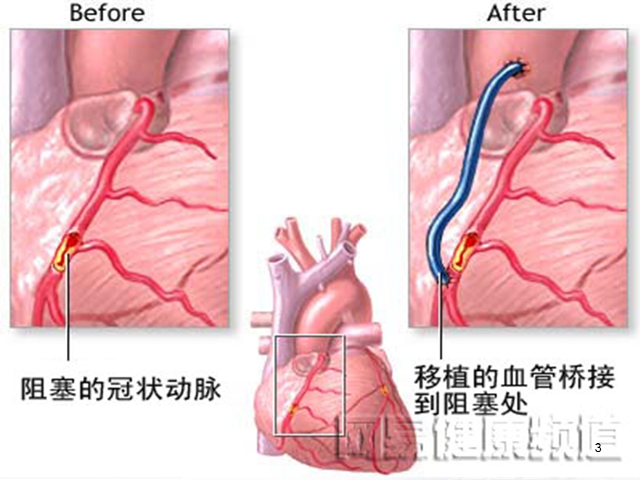 冠脉搭桥术后护理医学课件.ppt_第3页