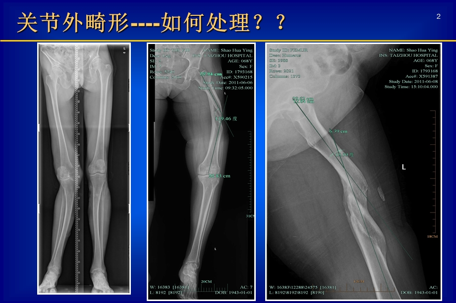 关节外畸形全膝课件.ppt_第2页