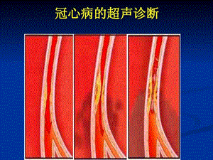 冠心病的超声诊断课件.ppt