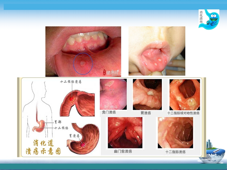 公开课消化性溃疡病人护理评估课件.ppt_第3页