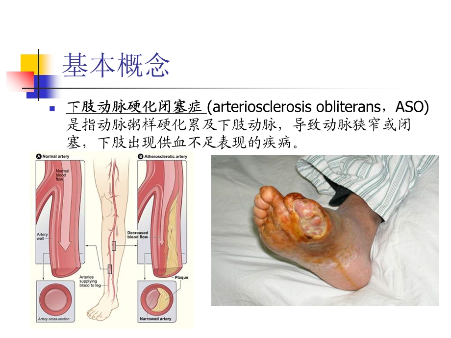 下肢动脉硬化闭塞的临床特点及治疗教学提纲ppt课件.ppt_第2页