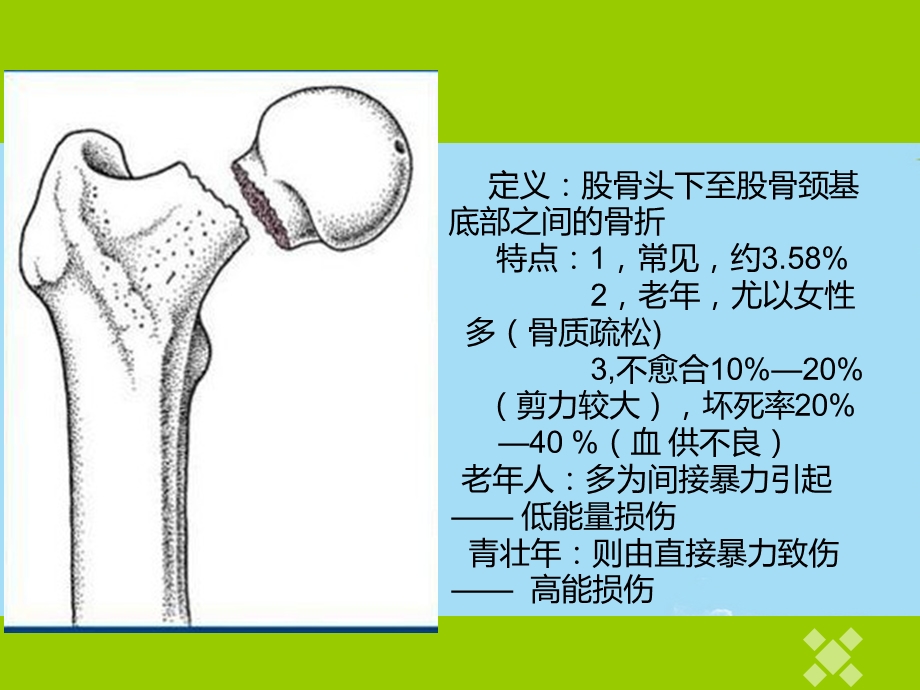 加压空心螺纹钉治疗股骨颈骨折课件.ppt_第2页