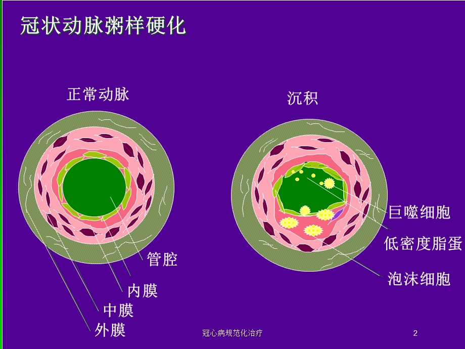 冠心病规范化治疗培训课件.ppt_第2页