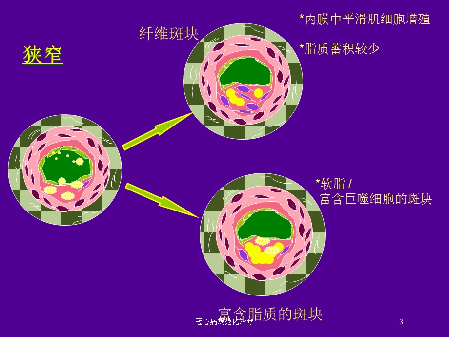 冠心病规范化治疗培训课件.ppt_第3页