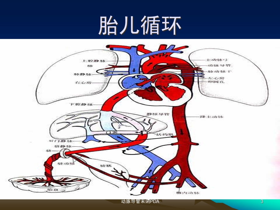 动脉导管未闭PDA培训课件.ppt_第3页