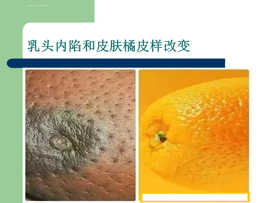 乳腺癌诊疗流程ppt课件.ppt_第3页