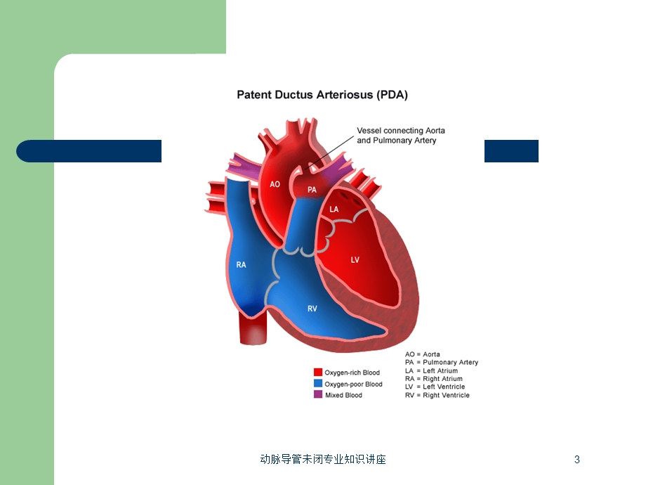 动脉导管未闭专业知识讲座培训课件.ppt_第3页