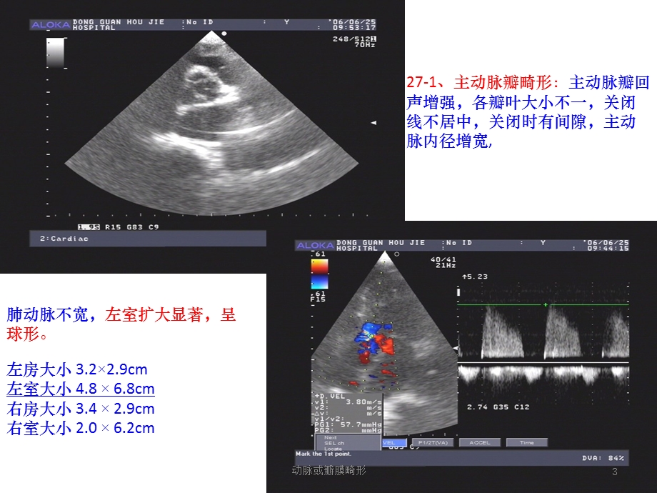 动脉或瓣膜畸形培训课件.ppt_第3页