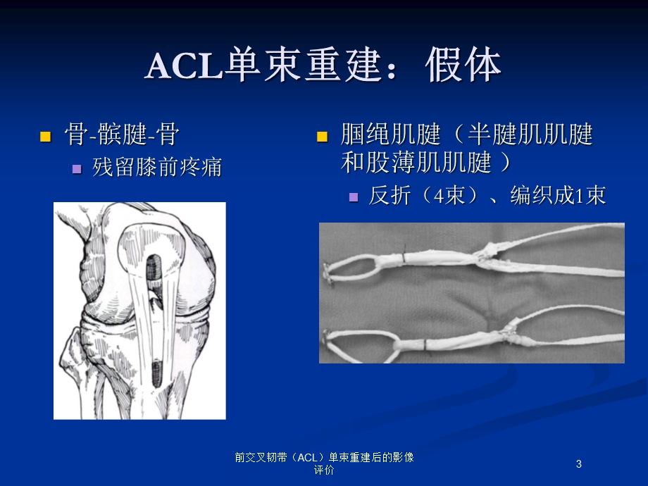 前交叉韧带(ACL)单束重建后的影像评价培训课件.ppt_第3页