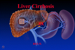 内科学课件09肝硬化和肝性脑病.ppt