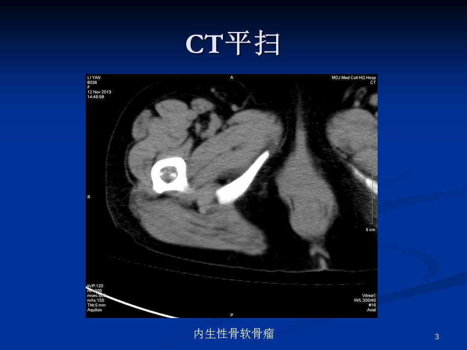 内生性骨软骨瘤培训课件.ppt_第3页