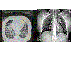 内科学多媒体课件间质性肺疾病.ppt