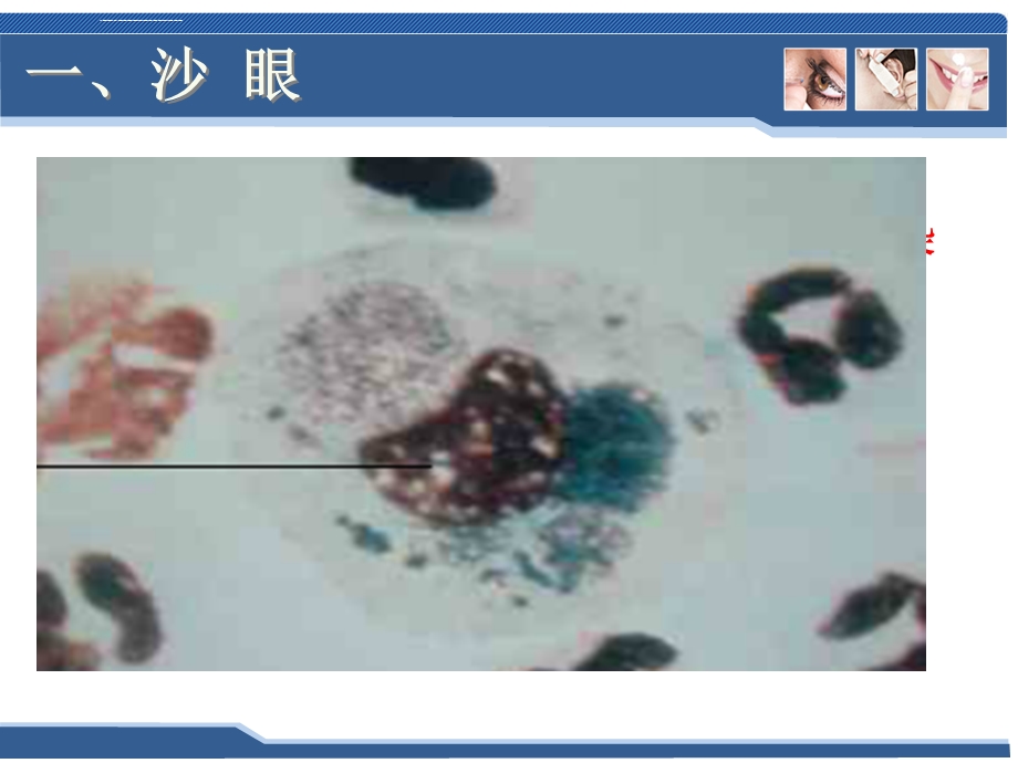 五官科学第三章眼科常见疾病3结膜病二沙眼ppt课件.ppt_第3页