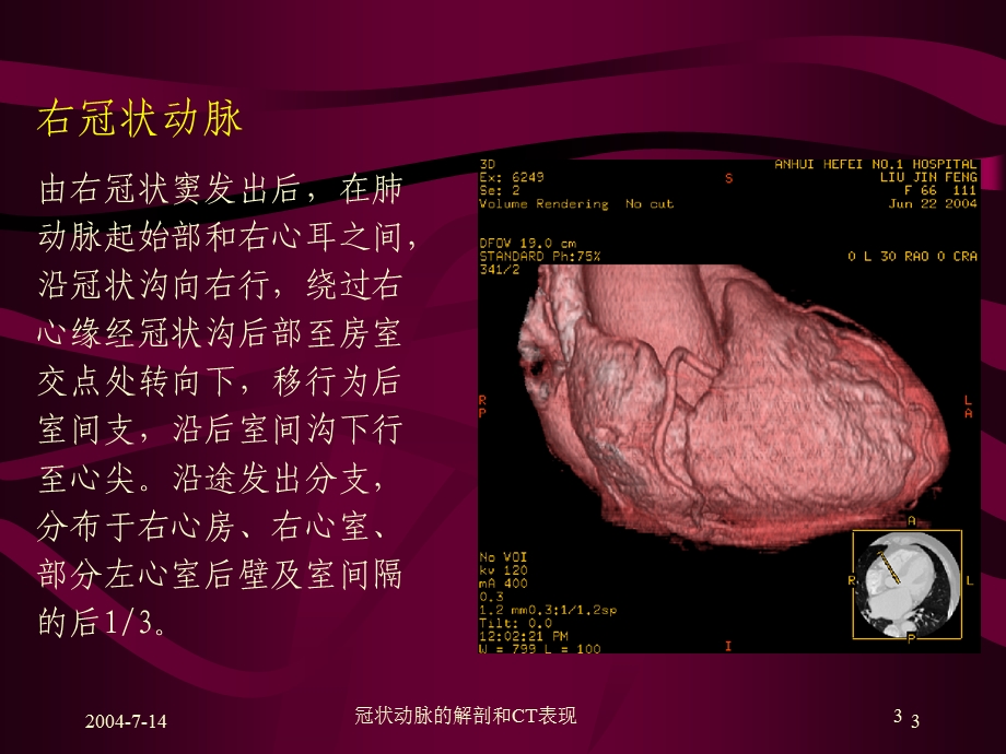 冠状动脉的解剖和CT表现培训课件.ppt_第3页