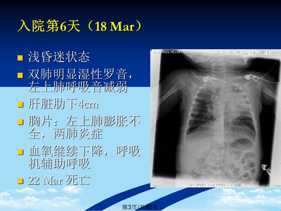 儿科肺炎全面版课件.pptx_第3页