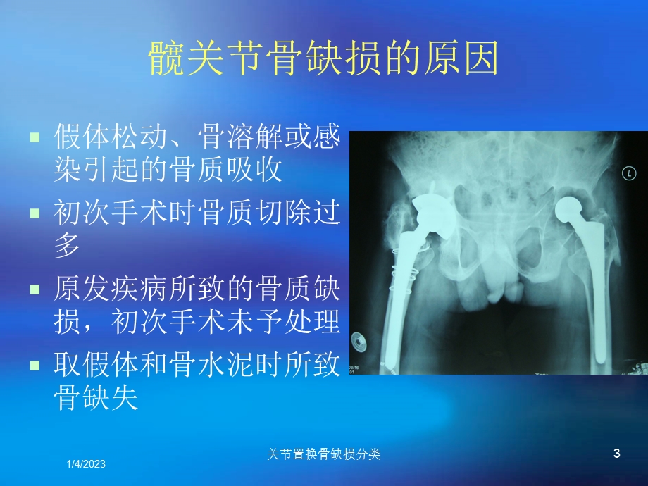 关节置换骨缺损分类课件.ppt_第3页