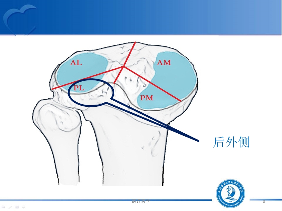 后外侧胫骨平台骨折(行业运用)课件.ppt_第3页