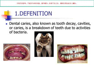 口腔龋病示教英文版课件.ppt