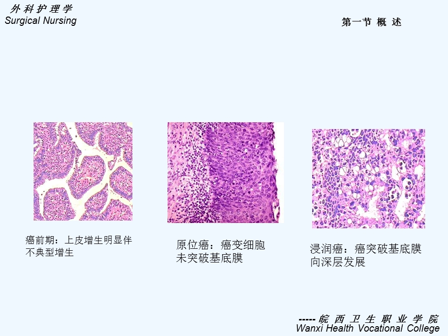 十章肿瘤病人护理中专好课件.ppt_第3页