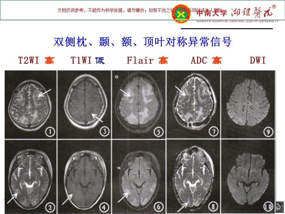 可逆性后部脑病综合征课件.ppt_第3页