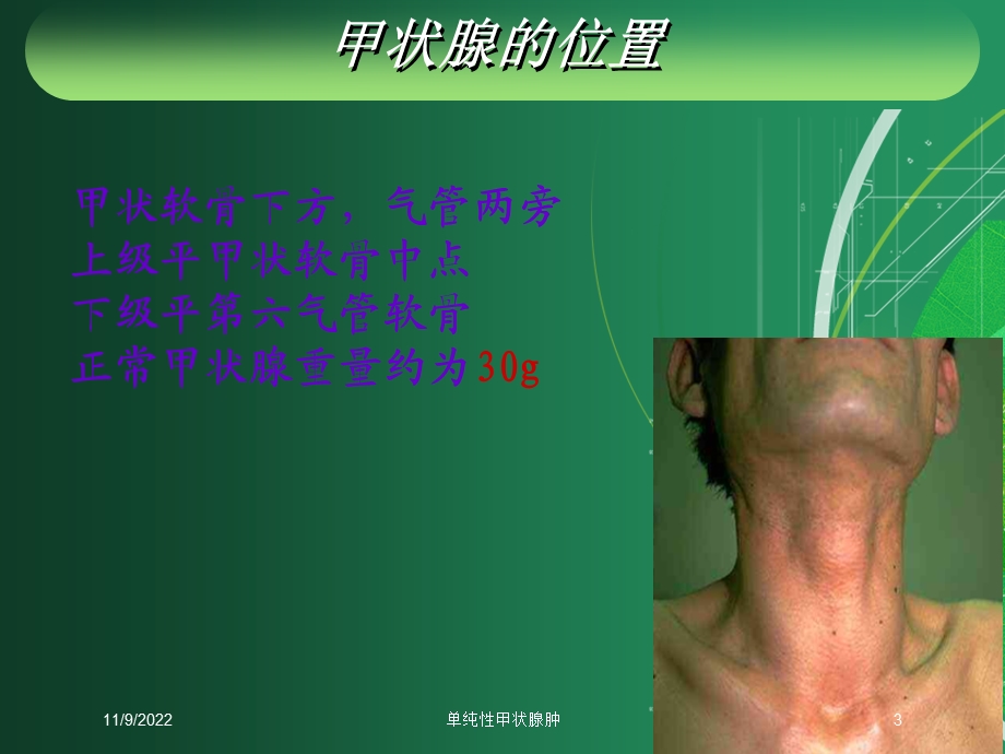 单纯性甲状腺肿培训课件.ppt_第3页