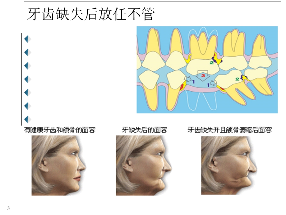 口腔种植课件.ppt_第3页