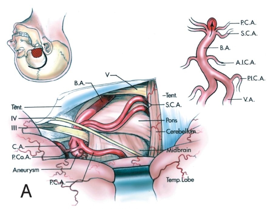 后循环动脉瘤手术入路课件.ppt_第3页