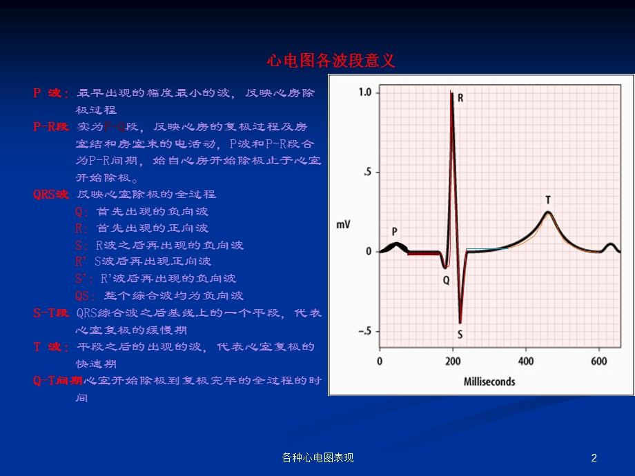 各种心电图表现培训课件.ppt_第2页